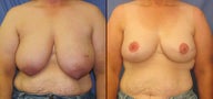Breast Reconstruction