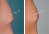 Male Breast reduction-Gynecomastia