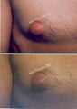 Male Breast reduction-Gynecomastia