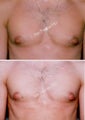 Male Breast reduction-Gynecomastia