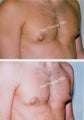 Male Breast reduction-Gynecomastia. Reduced size of nipples. 