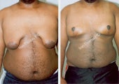 Male Breast reduction and lift-Gynecomastia