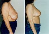 Breast Reduction