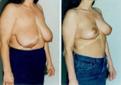 Breast Reduction
