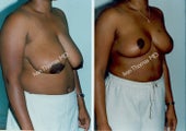Breast Reduction
