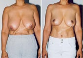 Breast Reduction