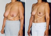 Breast Reduction