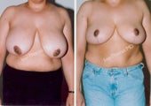 Breast Reduction