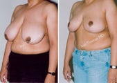 Breast Reduction