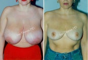 Breast Reduction