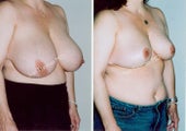 Breast Reduction