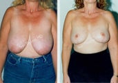 Breast Reduction