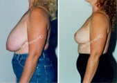 Breast Reduction