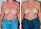 Breast Reduction