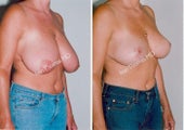Breast Reduction