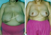 Breast Reduction