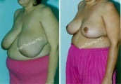 Breast Reduction