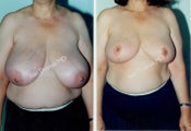 Breast Reduction