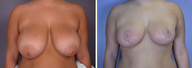 Breast Reduction & Lift