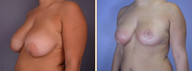 Breast Reduction & Lift