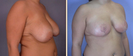 Breast Reduction & Lift