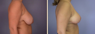 Breast Reduction & Lift
