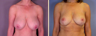 Breast Reduction