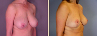 Breast Reduction