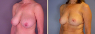 Breast Reduction