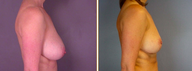 Breast Reduction