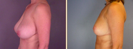 Breast Reduction