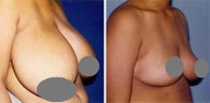Breast Reduction with Uplift