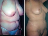 57 year old female, breast reduction