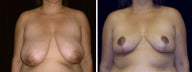 37 year old female, breast reduction
