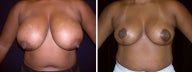 40 year old female, breast reduction