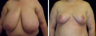 45 year old female, breast reduction
