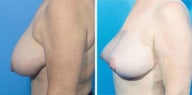 Breast Reduction