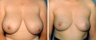 Breast Reduction