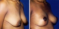 Breast Reduction