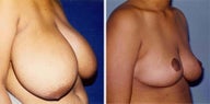 Breast Reduction