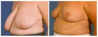 Breast Reduction