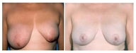 Breast Reduction