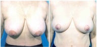 Breast Reduction