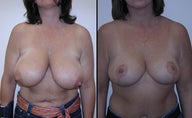 Breast Reduction