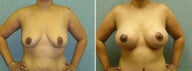 Breast lift with implants
