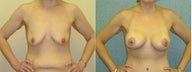 Breast lift with implants