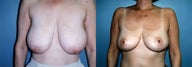 Breast Reduction & Mammoplasty