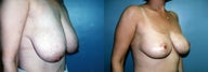 Breast Reduction & Mammoplasty