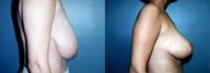 Breast Reduction & Mammoplasty