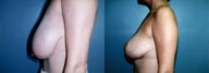 Breast Reduction & Mammoplasty
